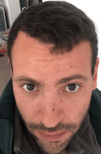 Anthony G. after