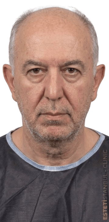 Luigi L. before