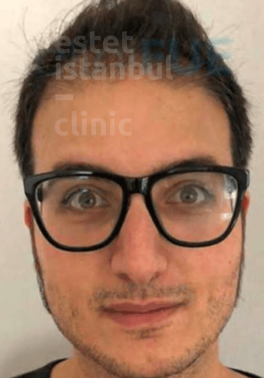 Julien G. before